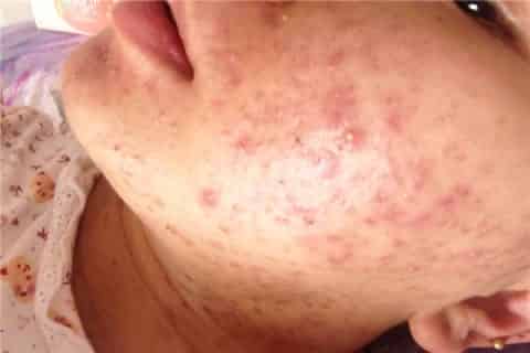 痤疮里面是什么东西