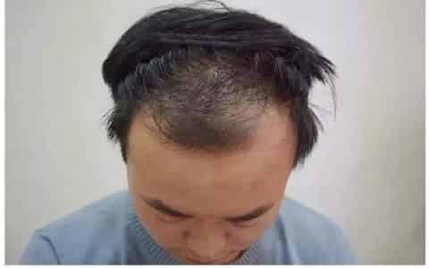 发际线后移擦生姜行吗