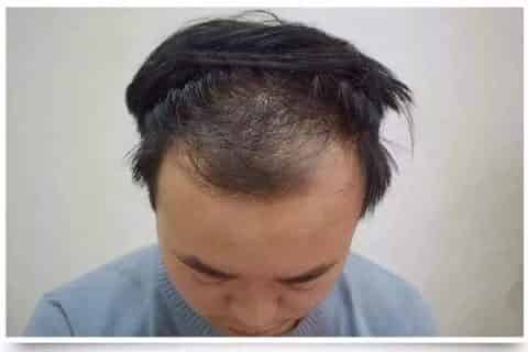 发际线后移擦生姜行吗